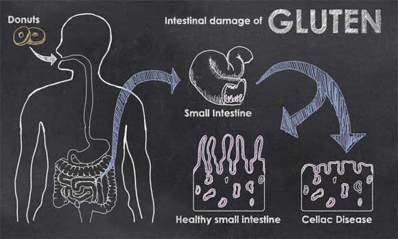 damaged villi lactose intolerance